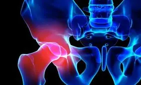 ورزش‌های مناسب برای درمان آرتروز لگن+ تصاویر