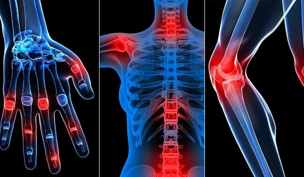 بیماریهای روماتیسم؛ شایعترین علل معلولیت