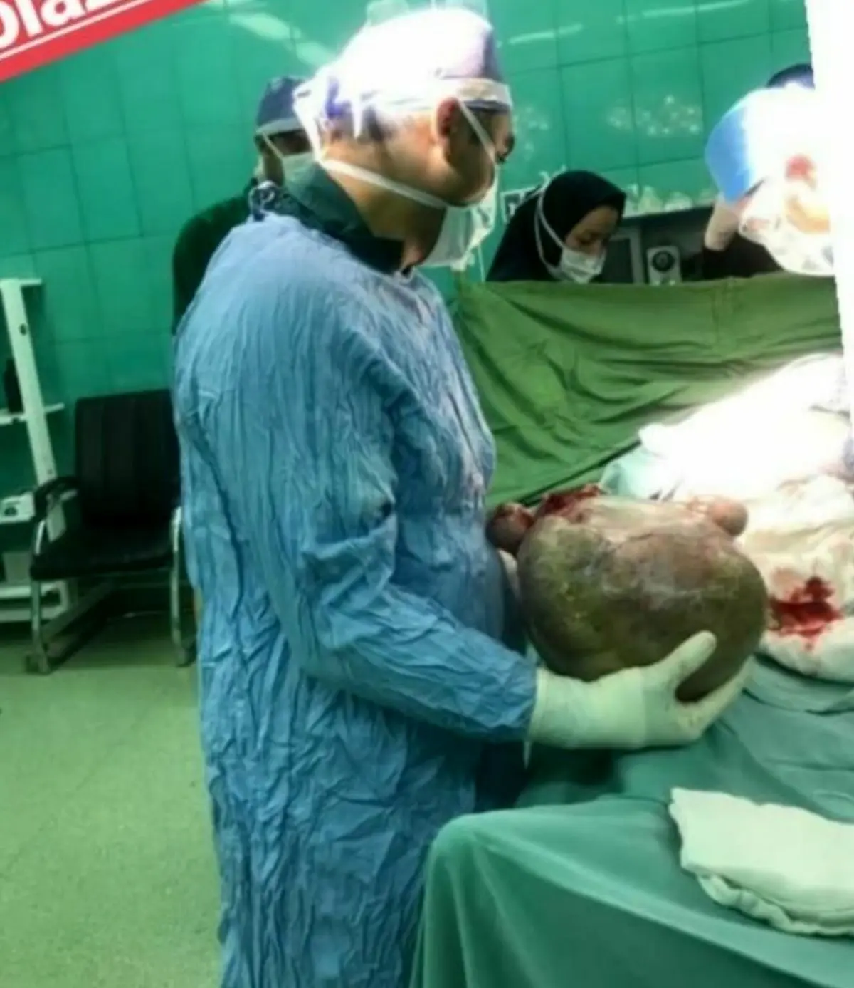 خارج کردن غده ۲۷ کیلویی از شکم زن ۴۸ ساله در سیرجان