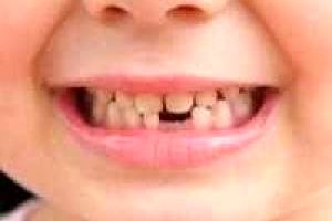 نکاتی جدی از دندان شیری کودکان