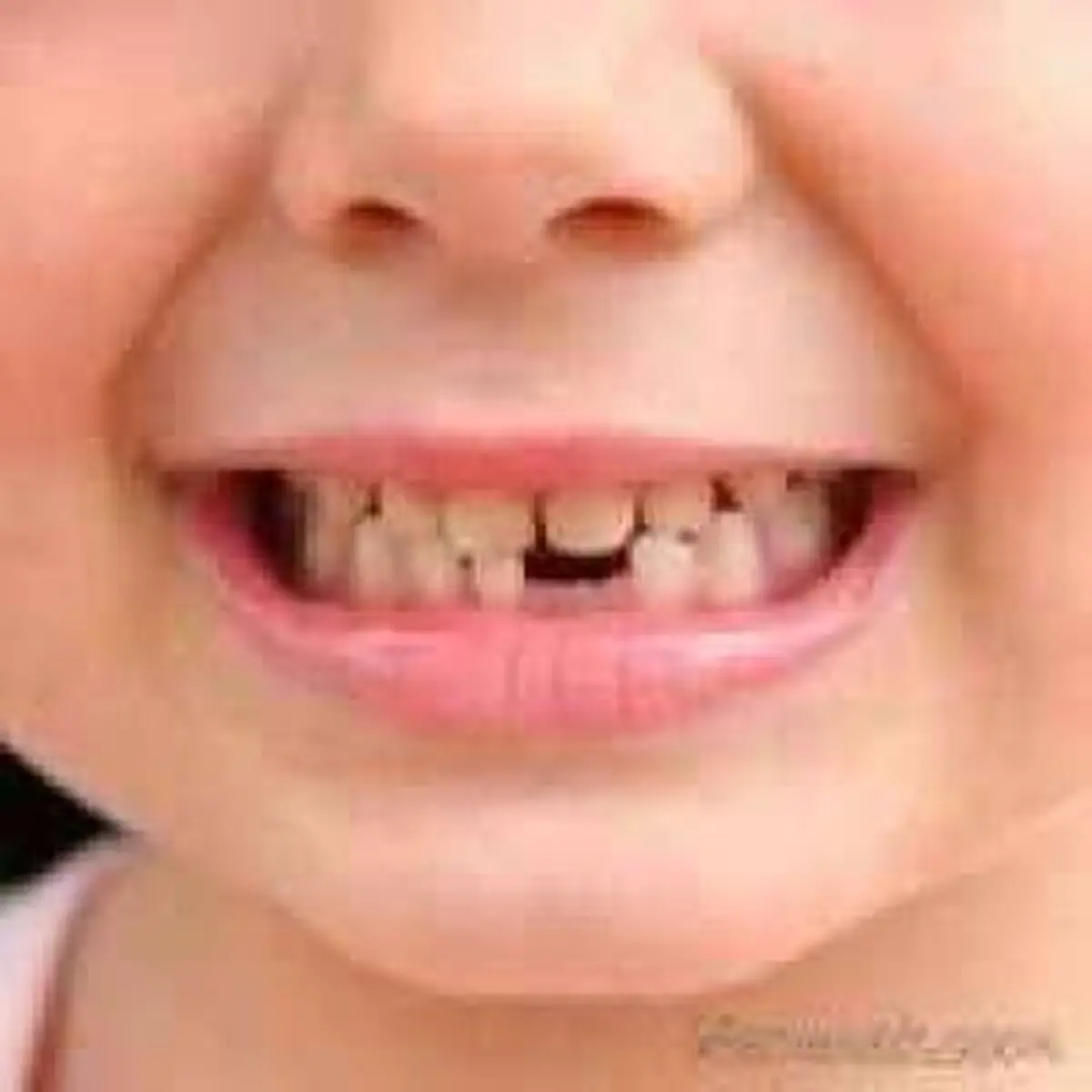 نکاتی جدی از دندان شیری کودکان