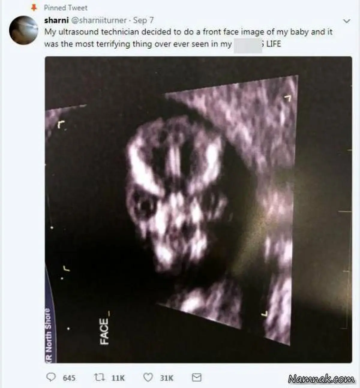 وحشت مادر از عکس سونوگرافی جنین داخل شکمش + عکس