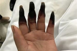 زخمی که انگشتان دست یک زن را خورد + تصاویر 16+