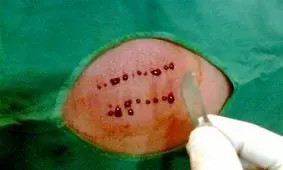 نامناسب‌ترین اوقات برای "حجامت" را بشناسید