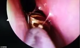 خارج کردن سوسک زنده از جمجمه زن هندی توسط پزشکان