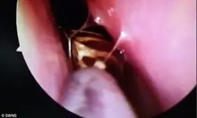 خارج کردن سوسک زنده از جمجمه زن هندی توسط پزشکان