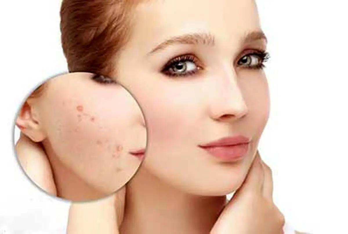 علت جوش زدن پوست در زمستان