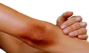 با ۱۰ روش طبیعی و مؤثر برای رفع تیرگی زانو و آرنج آشنا شوید