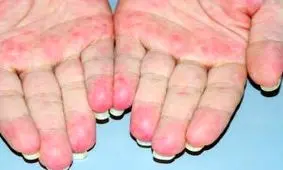 از علل و علائم تا تشخیص و درمان بیماری واسکولیت