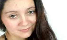 جوش نزن تا جوش نزنی!!(علل،پیشگیری،درمان)