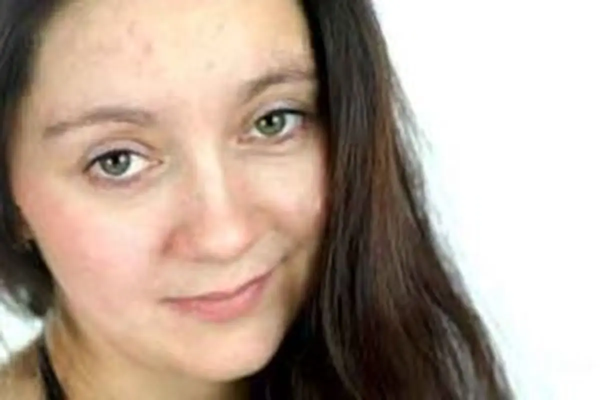 جوش نزن تا جوش نزنی!!(علل،پیشگیری،درمان)