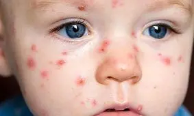 کنترل بیماری‌ها با رژیم غذایی مخصوص+ برنامه غذایى ویژه آبله مرغان