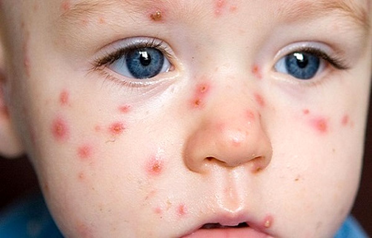 کنترل بیماریها با رژیم غذایی مخصوص+ برنامه غذایى ویژه آبله مرغان