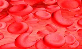 کم خونی داسی شکل و آنچه باید در این مورد بدانید