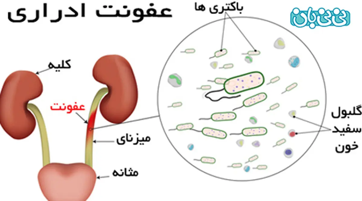 چرا عفونت ادراری در کودکان دختر بیشتر است ؟