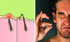 مو‌های زیر پوستی چرا به وجود می‌آیند و چطور می‌توان جلوی رشدشان را گرفت؟