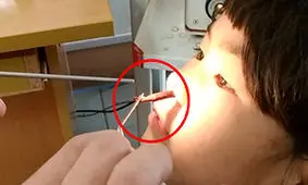 بیرون کشیدن زالوی بزرگ از داخل بینی یک دختربچه + فیلم