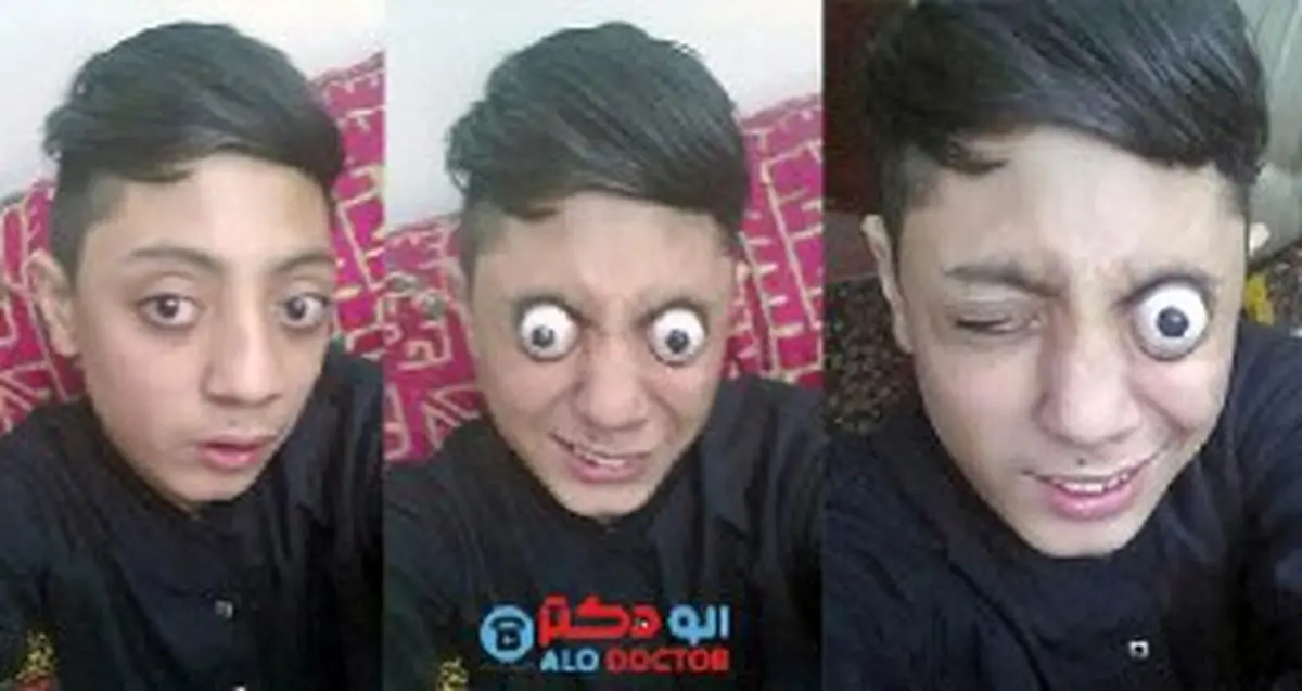 پسری که چشمانش از حدقه بیرون می زند!