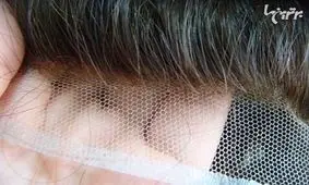 پروتز مو و هر آنچه باید بدانید