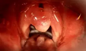 هر آنچه باید در مورد انواع پولیپ و درمان آن ها بدانید