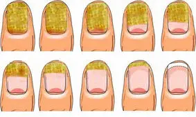 درمان قارچ ناخن با روش‌ های خانگی