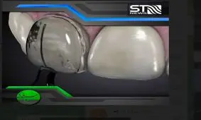 ترمیم، جرمگیری، لمینت و قالب گیری دندان