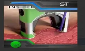 تکنولوژی جدید در بخیه زدن با گجتهای کوچک+فیلم