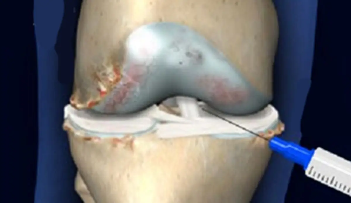 باید و نباید‌های تزریق ژل در زانوها که نمی‌دانید