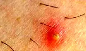 چطور می توان جلوی رشد موهای زیر پوستی را گرفت؟