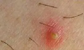 چطور می توان جلوی رشد موهای زیر پوستی را گرفت؟