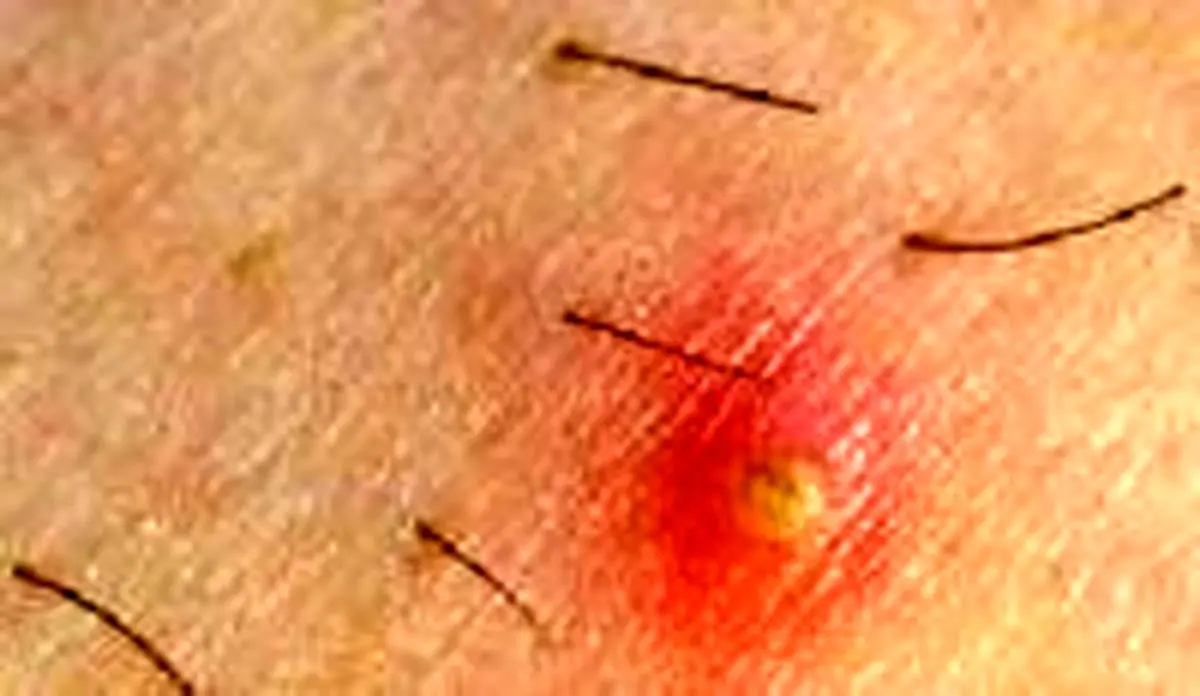 چطور می توان جلوی رشد موهای زیر پوستی را گرفت؟