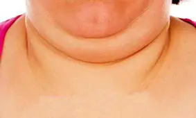 چگونه از غبغبم خلاص شوم ؟