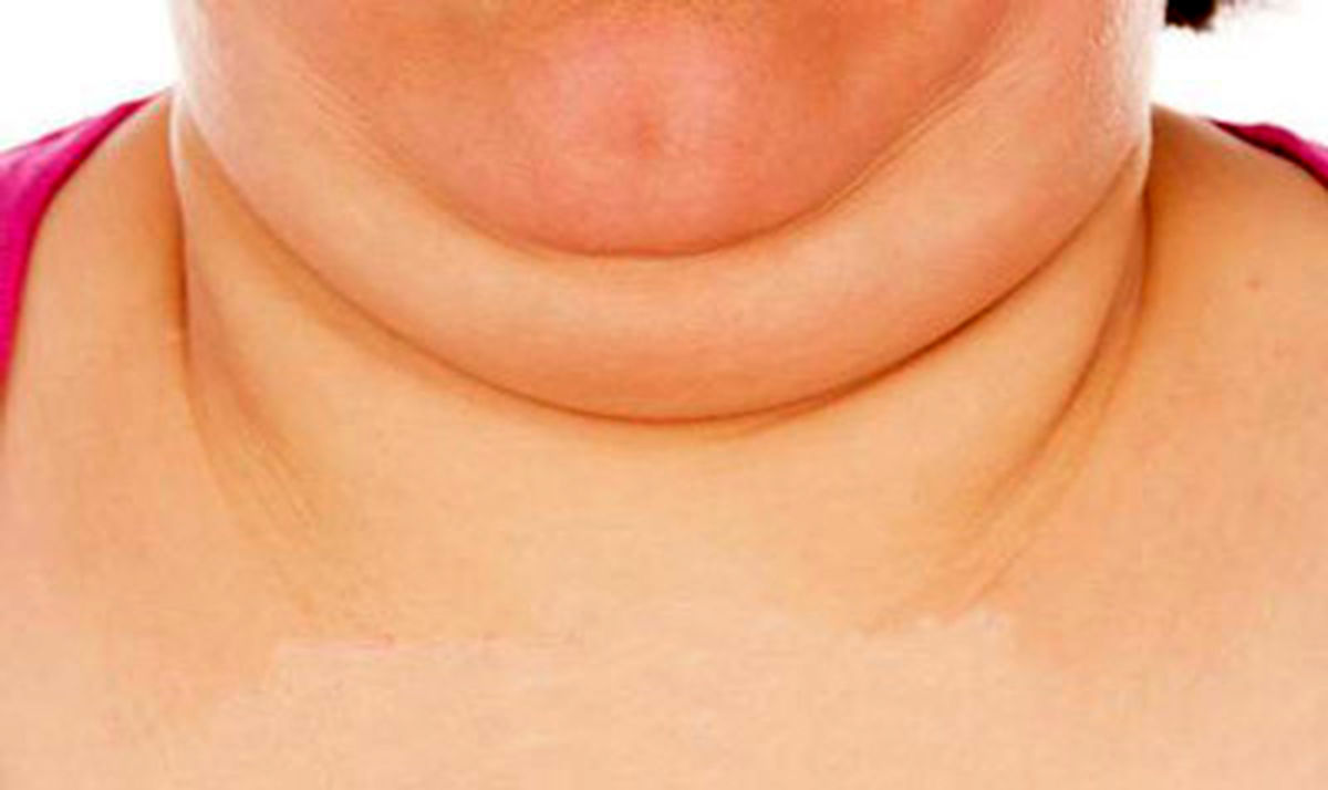 چگونه از غبغبم خلاص شوم ؟