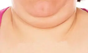 چگونه از غبغبم خلاص شوم ؟