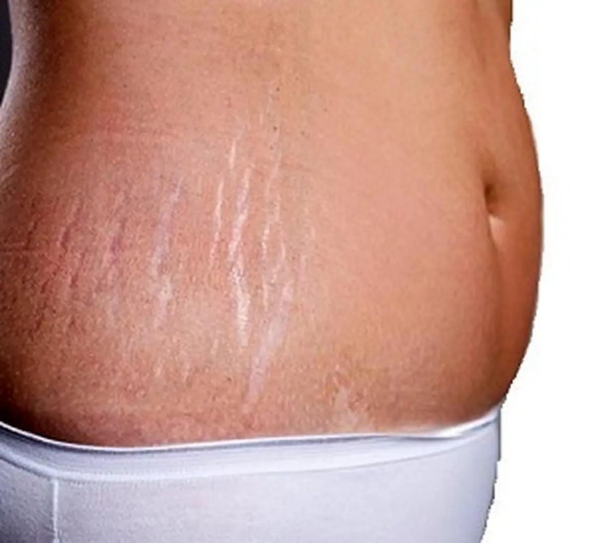 ترک های پوست را از بین ببرید