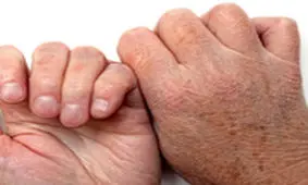 خال سرطانی روی کدوم دست ظاهر می شه؟