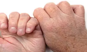 خال سرطانی روی کدوم دست ظاهر می شه؟