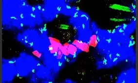 فناوری جدید سلول های سرطانی را خواب می کند