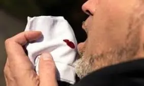 ایدزی که سل می سازد