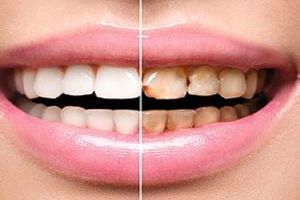 این عادت اشتباه دلیل پوسیدگی دندان شماست!