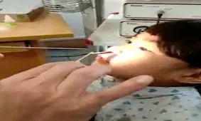 بیرون آمدن کرم زنده از بینی دختر 6 ساله ! + عکس