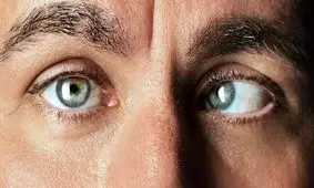 انحراف چشم و علل آن