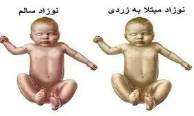 زردی نوزاد یا ایکتر چیست؟ + روش درمان زردی