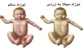 زردی نوزاد یا ایکتر چیست؟ + روش درمان زردی