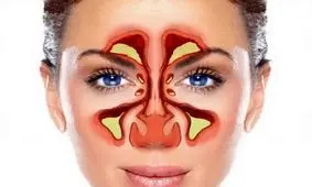 از کجا بفهمیم بیماری سینوزیت داریم؟