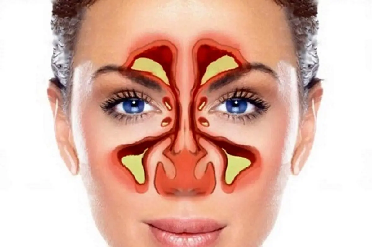 از کجا بفهمیم بیماری سینوزیت داریم؟