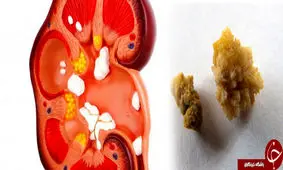 مهم‌ترین عوامل ایجاد سنگ کلیه چیست؟