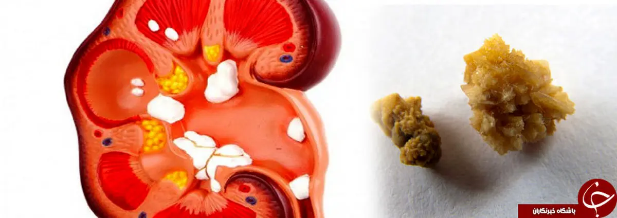 مهم‌ترین عوامل ایجاد سنگ کلیه چیست؟