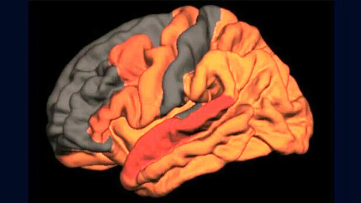 ارتباط کیفیت پایین خواب با ابتلا به آلزایمر