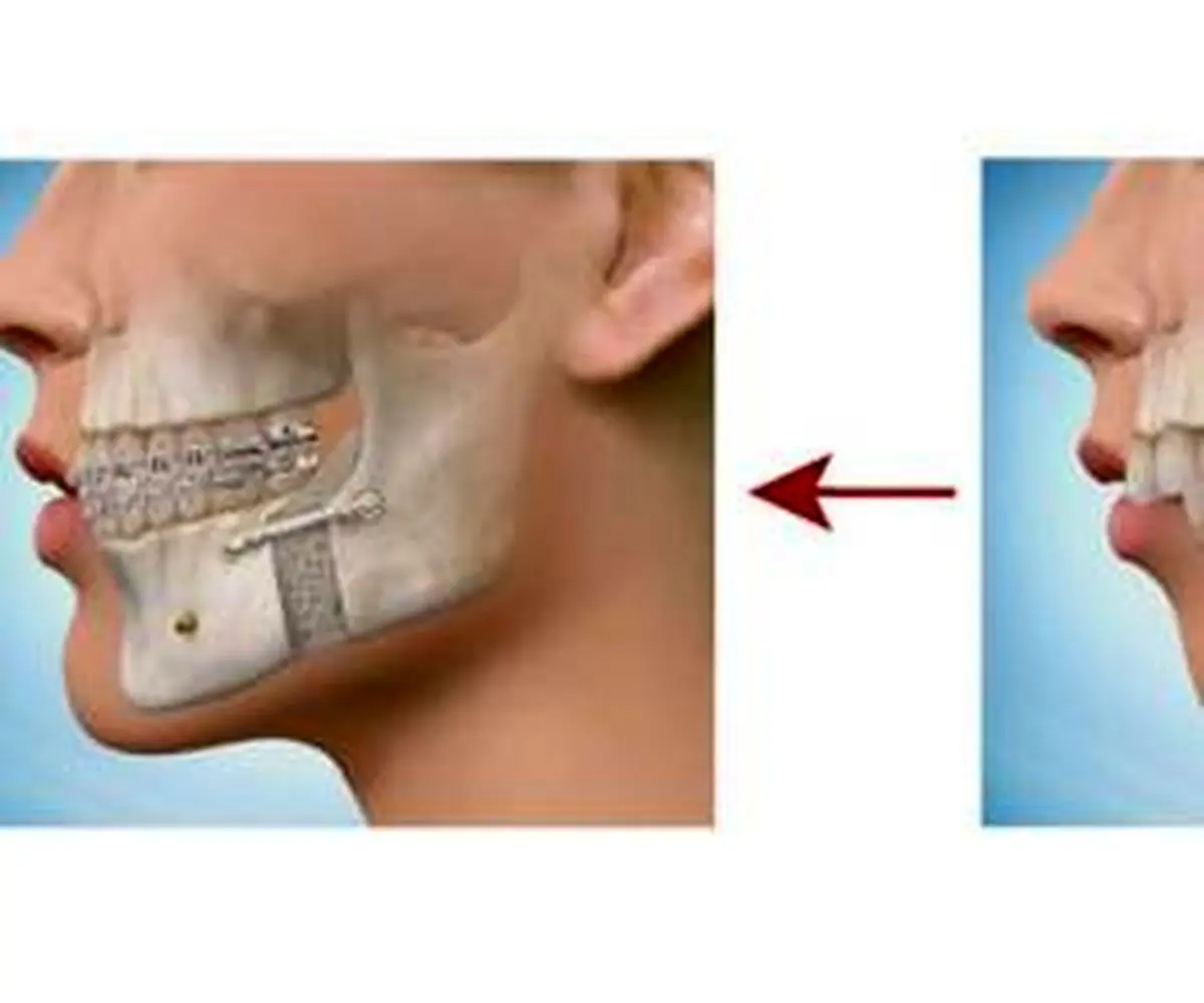 چانه هایی که نیاز به جراحی دارند